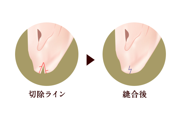 Z型形成術