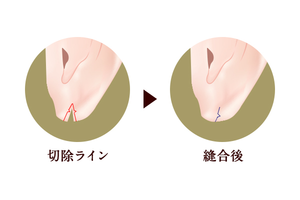 W形成術