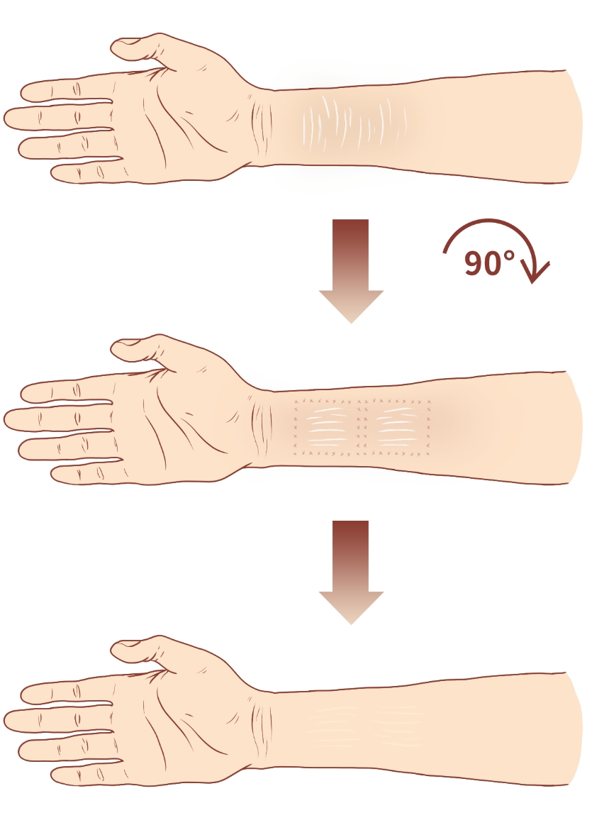 植皮法, Skin Grafting
