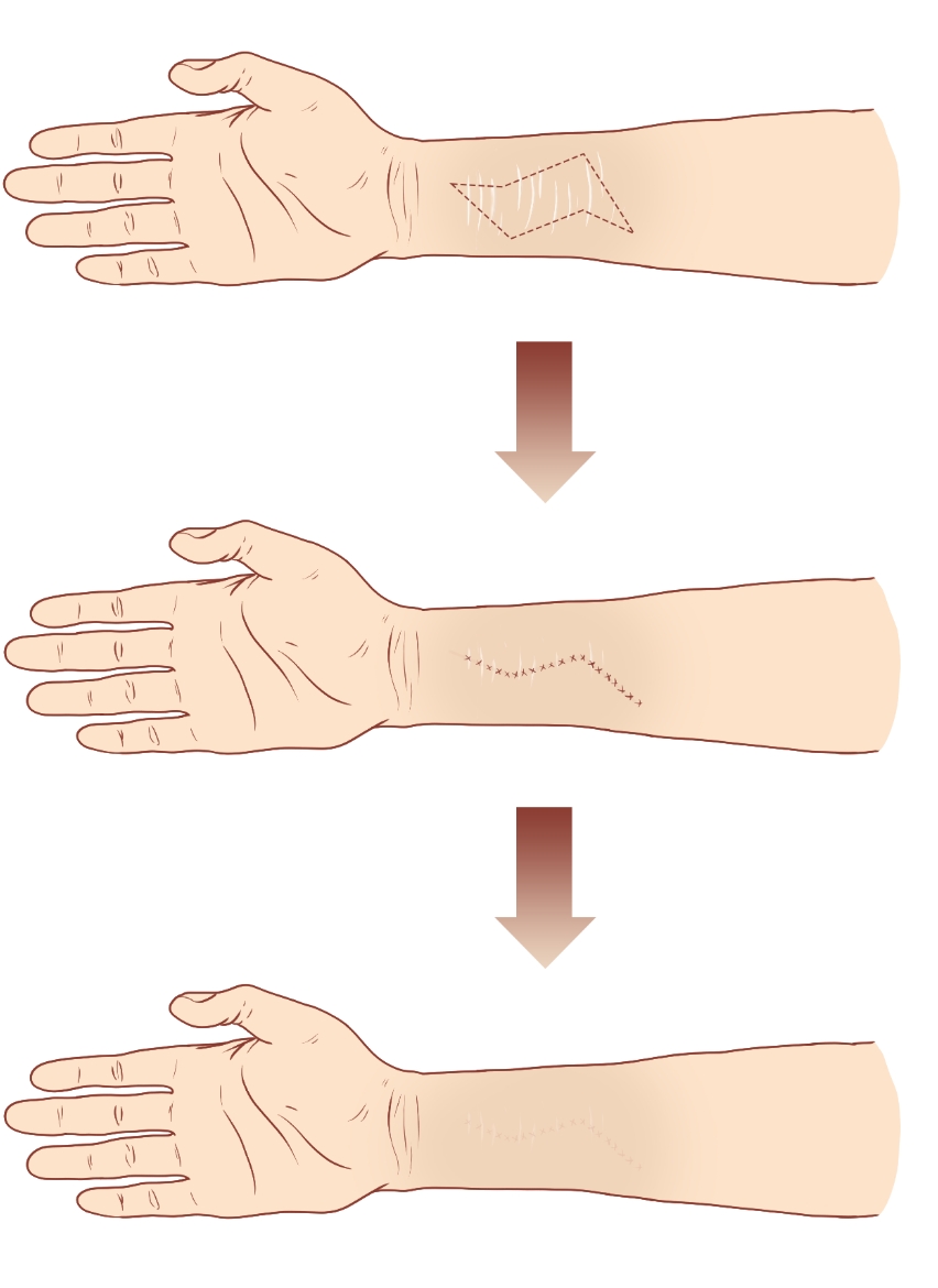 切除法, Ablation Method